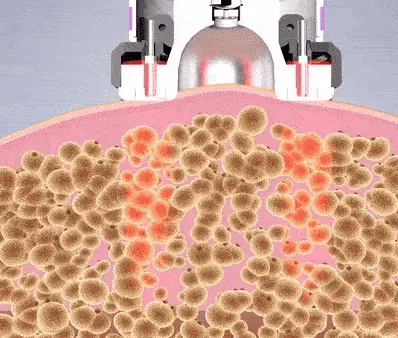 Cellulite Massager - Deep Vacuum therapy